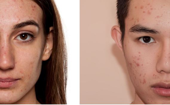 Teenage Acne vs Adult Acne