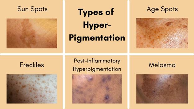 Types of hyperpigmentation