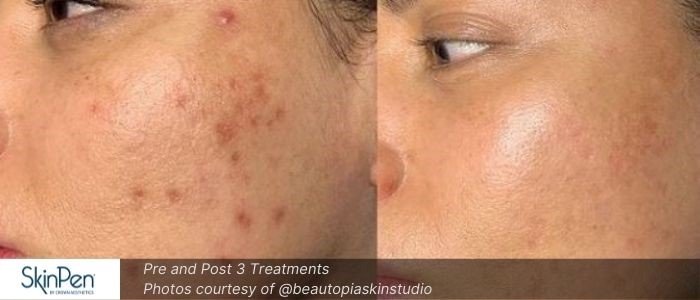 Before and After 3 Treatments