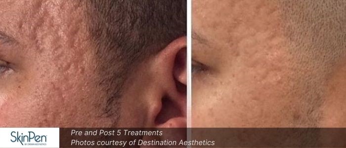Before and After Microneedling 3