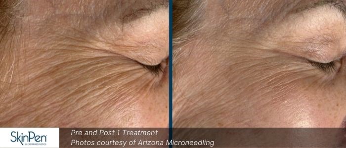 Before and After Microneedling 6