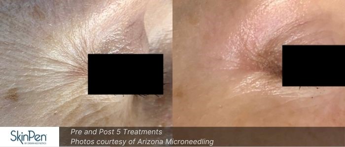 Before and After Microneedling 7