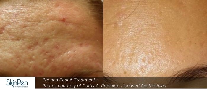 Before and After Microneedling 8